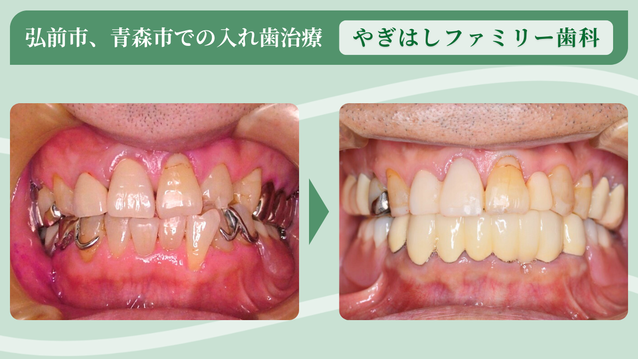 噛む力が非常に強い60代男性の部分入れ歯の治療例